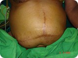incisional hernia lap repair 1d